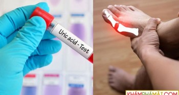 Top 10 cách "đào thải" acid uric một cách tự nhiên, ngừa gout hiệu quả: Nhiều người chưa biết để làm!