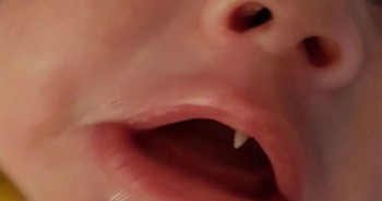 Chiếc răng nanh như Dracula trong miệng em bé 11 tuần tuổi