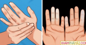 Cẩn thận với căn bệnh khiến ngón tay ngón chân bạn đổi màu trắng xanh khi gặp trời lạnh