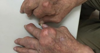 Bệnh Gout: Nguyên nhân, triệu chứng và cách điều trị
