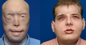 Các bác sĩ Pháp vừa làm nên lịch sử, khi cấy ghép khuôn mặt lần thứ hai cho cùng một người