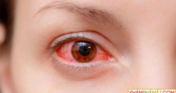 Nhìn người đau mắt đỏ có lây không?