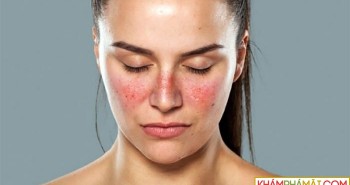 12 dấu hiệu cảnh báo bệnh lupus ban đỏ