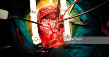 Lần đầu tiên trên thế giới, thay van tim không cần phẫu thuật mở