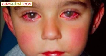 Những thủ phạm làm hại đôi mắt của bé mà cha mẹ không ngờ tới