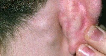 Nguyên nhân gây u cục sau tai? Khi nào cần thăm khám bác sĩ?