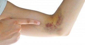 Vết bầm tím đột ngột xuất hiện trên da, bạn đã mắc bệnh gì?